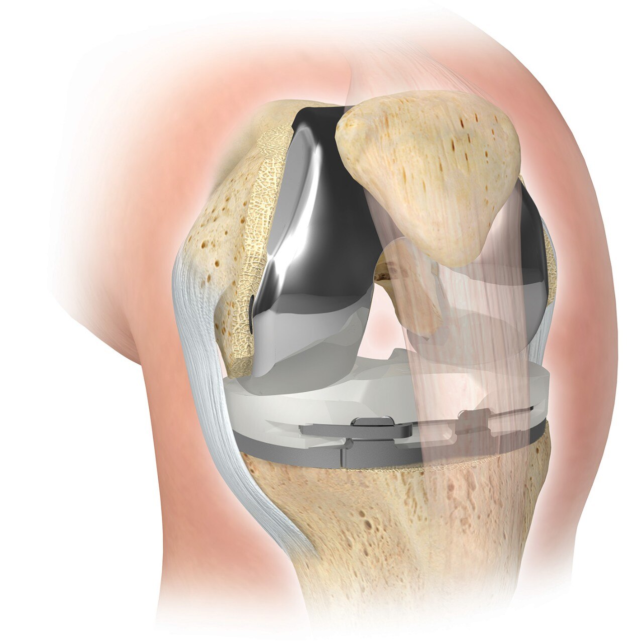 Reemplazo Total de Rodilla