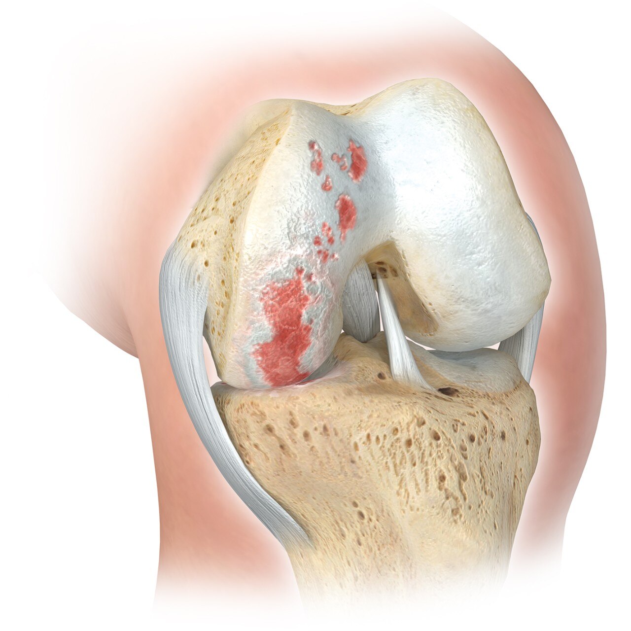 Rodilla dañada parcialmente