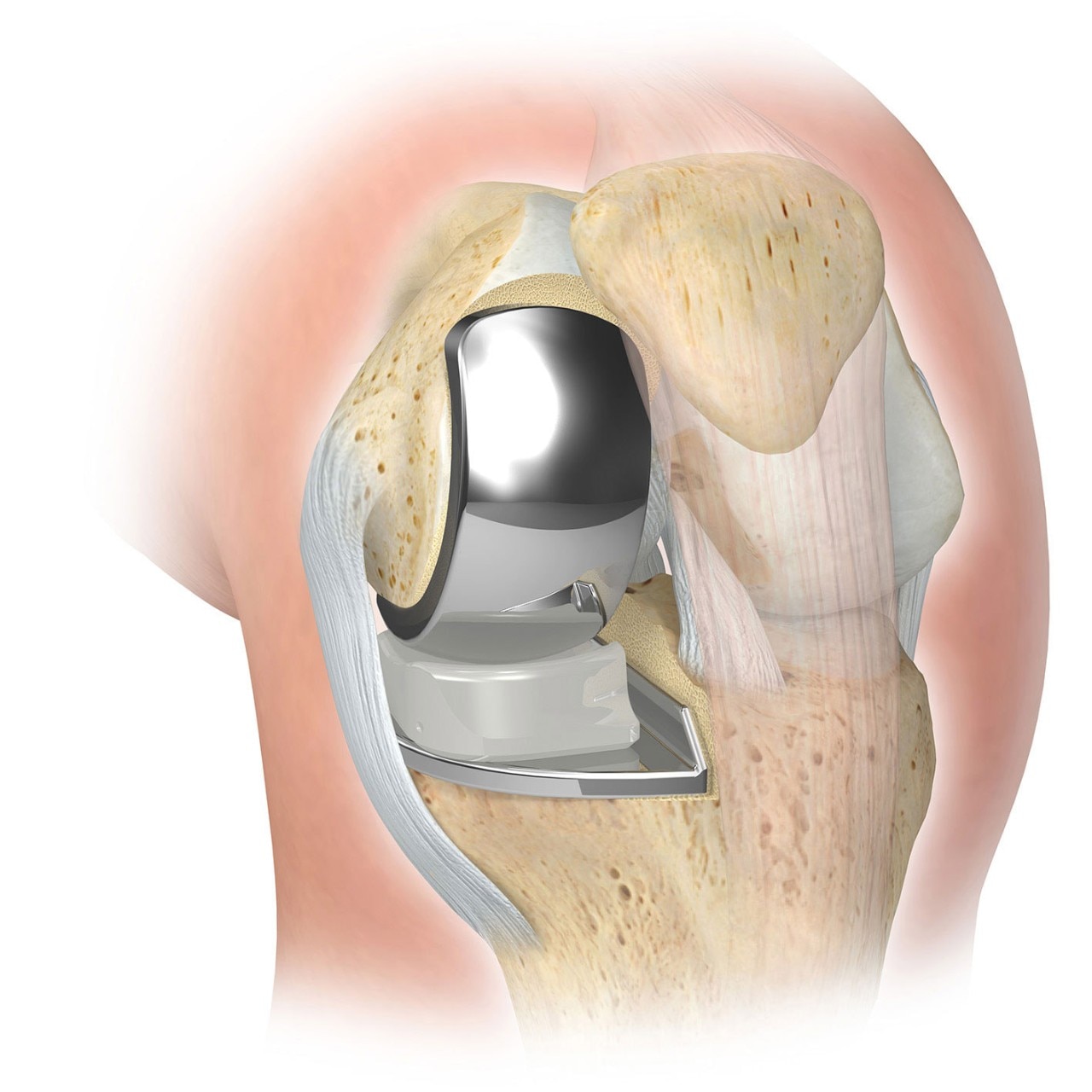 Reemplazo Parcial de Rodilla